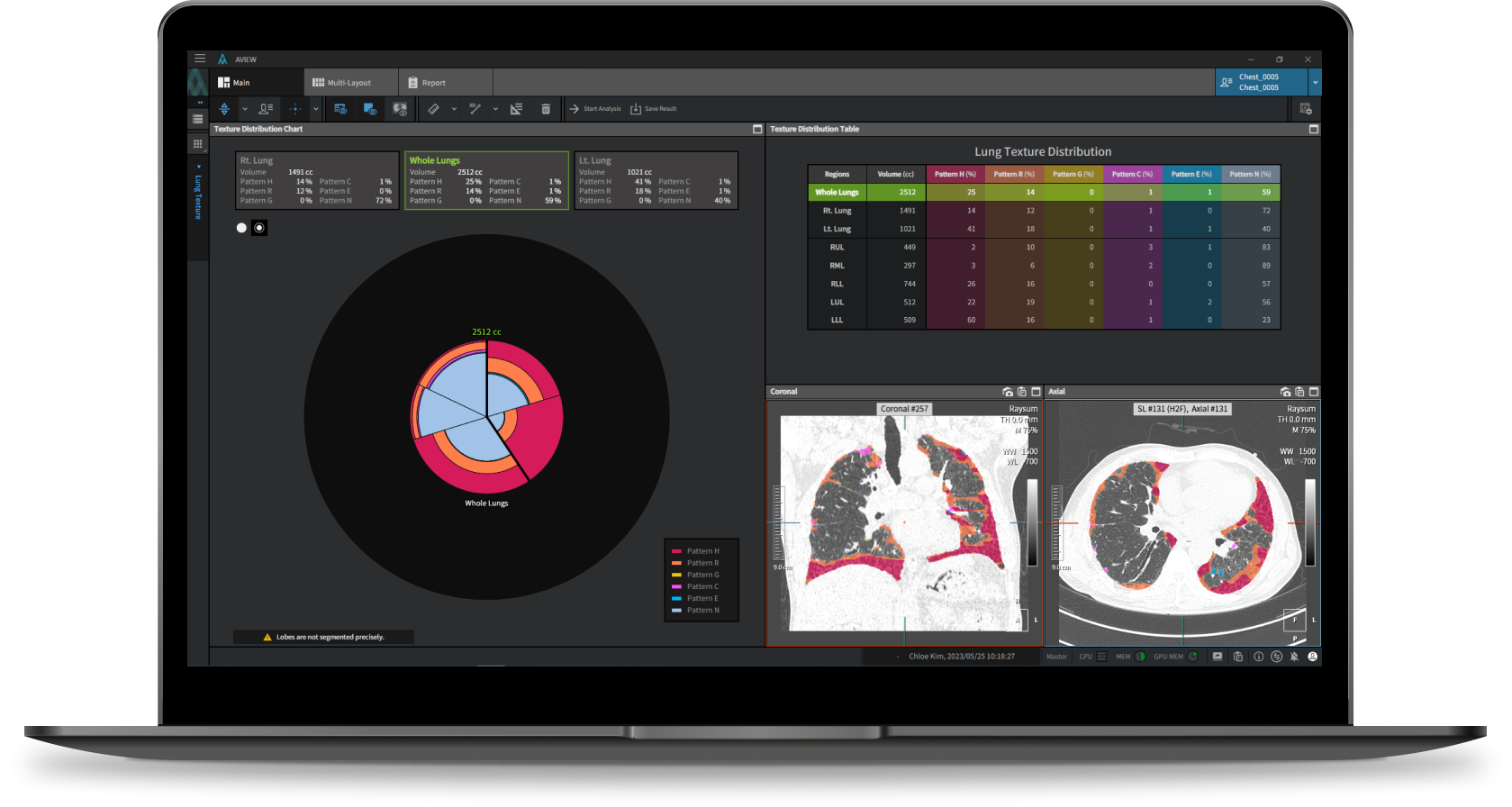 aview Lung Texture